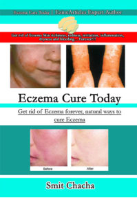 Eczema Cure Today - Get rid of Eczema forever natural ways to cure Eczema