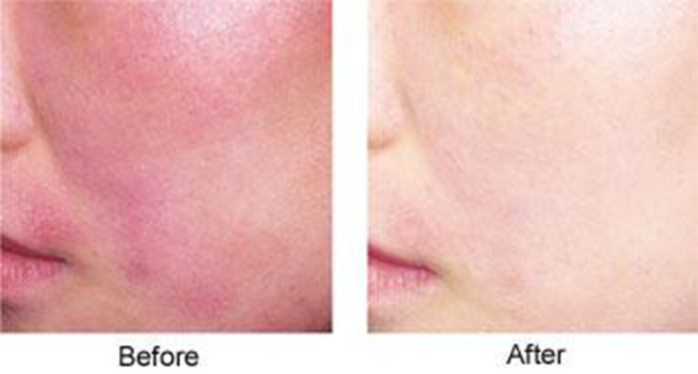 eczema before and eczema after*